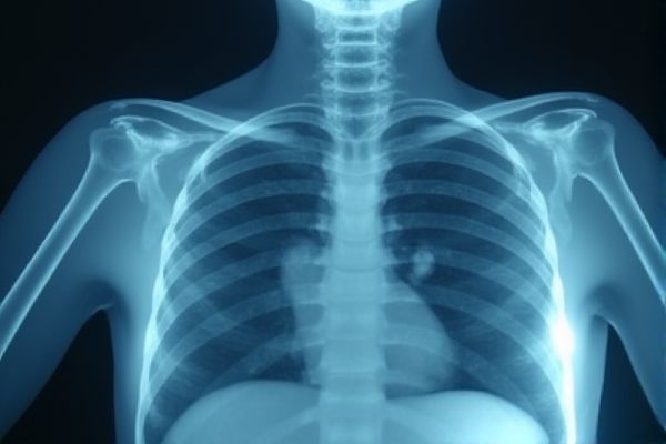 Tuberculosis Job Opportunities in Kenya